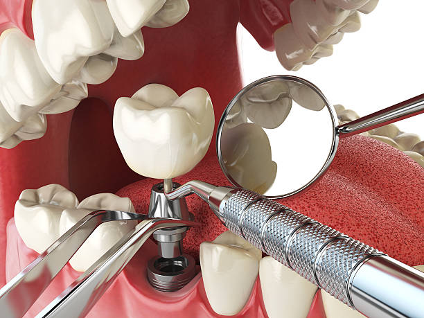 Best Emergency Denture Repair in Glasgow, OR